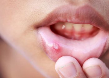 Menghilangkan Sariawan dengan Cepat dan Efektif, Panduan Lengkap