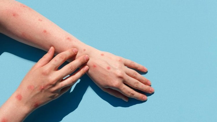 Mencegah Cacar Air, Panduan Lengkap Lindungi Diri dan Keluarga