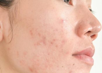 Cara Ampuh Menghilangkan Jerawat Merah di Pipi untuk Kulit Mulus